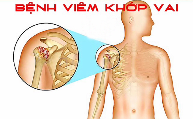 VIÊM QUANH KHỚP VAI CÓ THỂ GÂY TÀN PHẾ