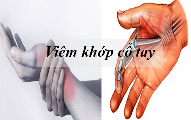 VIÊM KHỚP CỔ TAY LÀ GÌ VÀ LIỆU PHÁP ĐIỀU TRỊ
