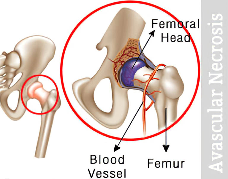 Liệu pháp Tiểu Châm Đao – Hỗ trợ điều trị viêm khớp háng hiệu quả.