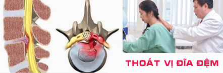 Thoát vị đĩa đệm