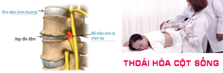 Bệnh thoái hóa cột sống
