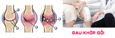 Bệnh đau khớp gối