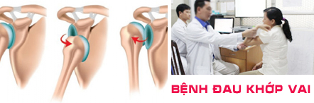 Bệnh đau khớp vai