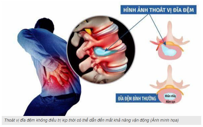 CHỮA THOÁT VỊ ĐĨA ĐỆM HIỆU QUẢ 95%
KHÔNG DÙNG THUỐC