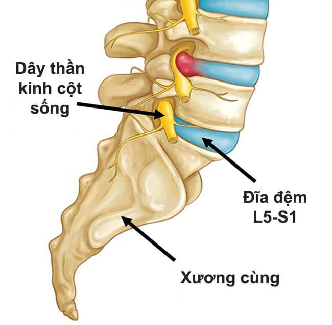 ĐIỀU TRỊ THOÁT VỊ ĐĨA ĐỆM CHỈ VỚI 40 PHÚT